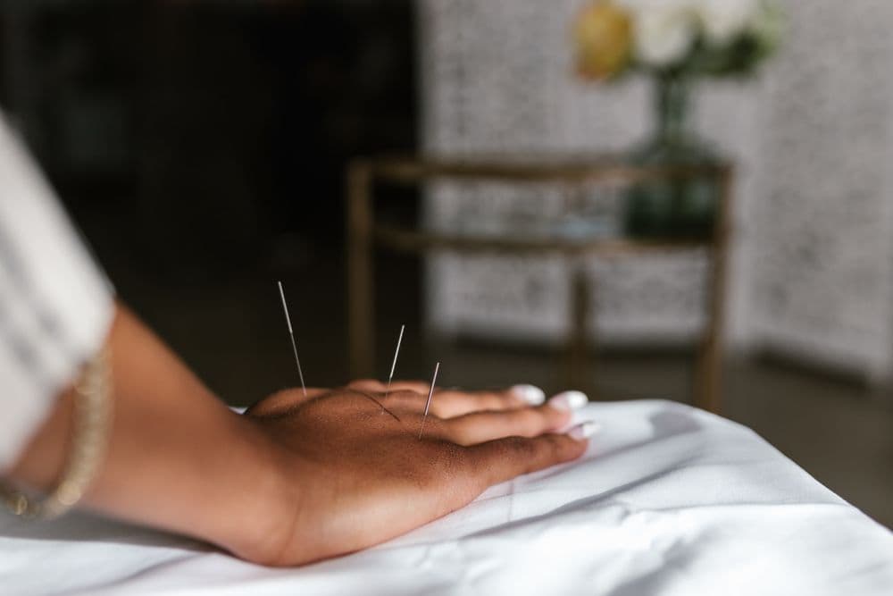 TCM Acupuncture Treatment